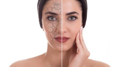 Dry Skin SOS: A Foolproof Skin Care Routine for Deep Hydration