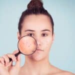 Avoid These Bad Habits & Get Rid of Acne Prone Skin: Your Complete Guide to Clear, Healthy Complexion