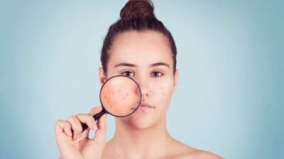 Avoid These Bad Habits & Get Rid of Acne Prone Skin: Your Complete Guide to Clear, Healthy Complexion